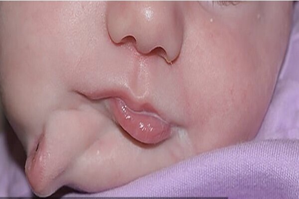 نوزادی با دو دهان متولد شد/ جراحی موفقیت آمیز دهان اضافه