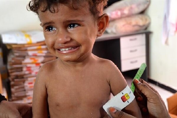 افزایش نگران کننده سوء تغذیه حاد در میان کودکان یمنی