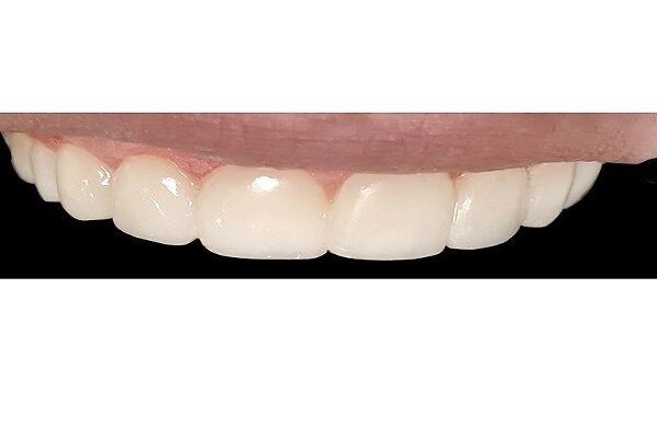 آنچه باید در مورد کامپوزیت دندان بدانید