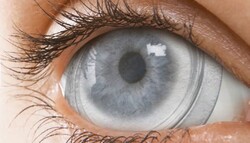 ارائه روشی برای رهایش دارو در راستای کنترل التهاب چشم