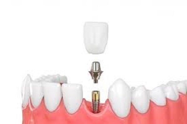 بررسی عصب کشی، ایمپلنت دندان و دندان مصنوعی
