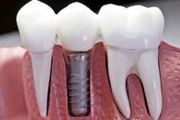 بررسی عصب کشی، ایمپلنت دندان و دندان مصنوعی