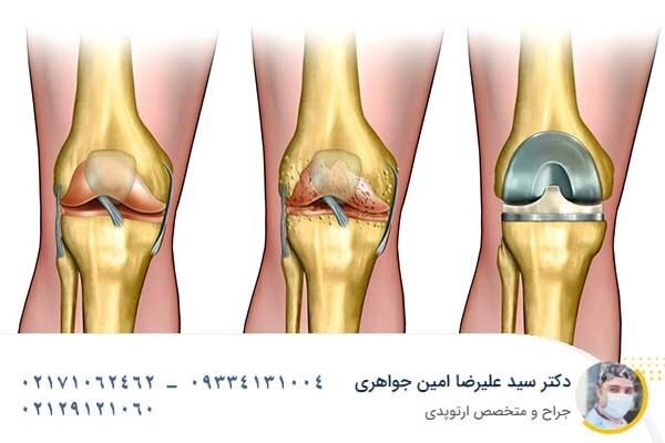 از جراحی‌های مفصل لگن و زانو نترسید 