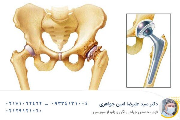 از جراحی‌های مفصل لگن و زانو نترسید