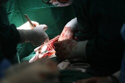 عمل جراحی دریچه قلب در اردبیل با موفقیت انجام شد