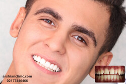 ۵ موردی که قبل از کامپوزیت دندان باید بدانید