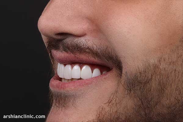 5 موردی که قبل از کامپوزیت دندان باید بدانید