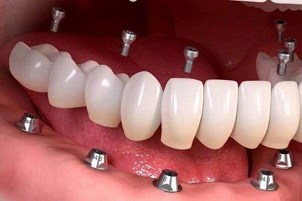 بررسی قیمت ایمپلنت دندان در سال ۱۴۰۰ + کد تخفیف ۲۰ درصد