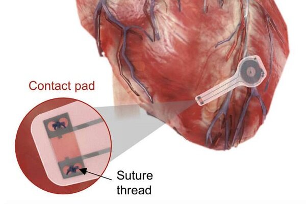 تولید اولین ضربان ساز مصنوعی قلب که در بدن حل می‌شود