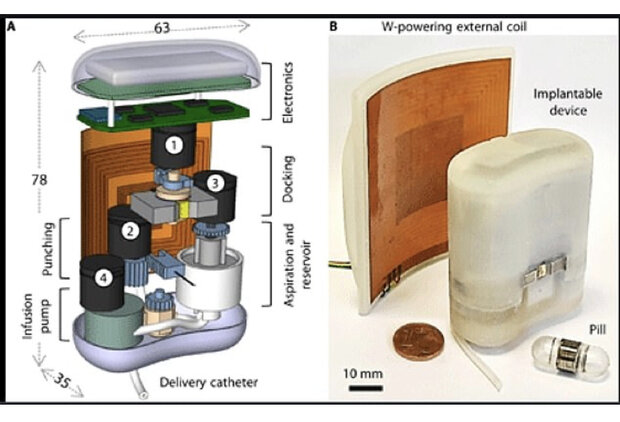 پمپ انسولین قابل ایمپلنت برای دیابتی ها 