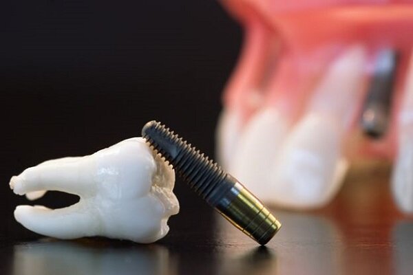 پاسخ به چند سوال متداول در مورد ایمپلنت و کاشت دندان