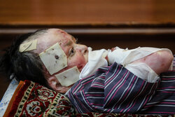 خانواده‌های دارای ازدواج فامیلی بیشتر به بیماری پروانه‌ای مبتلامی‌شوند