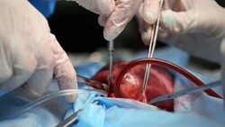 محققان گروه خونی کلیه پیوندی را تغییر دادند