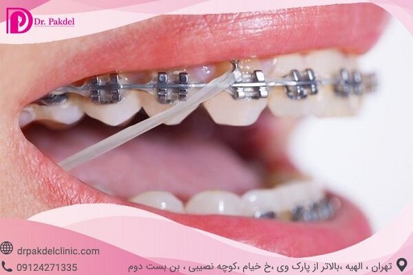 ارتودنسی دندان چیست؟ انواع ارتودنسی دندان