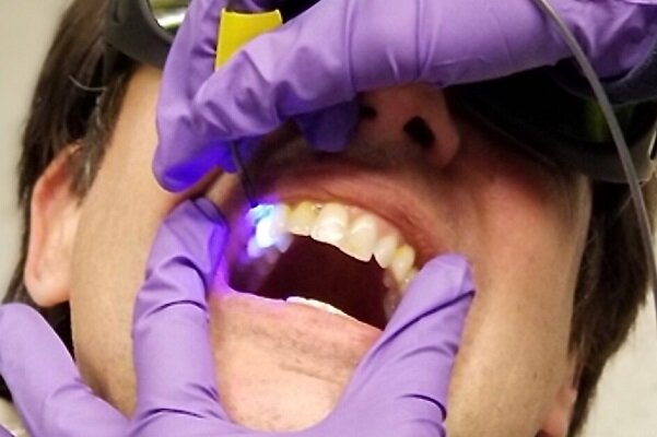 تولید حسگر برای شناسایی دندان‌های در معرض خطر پوسیدگی