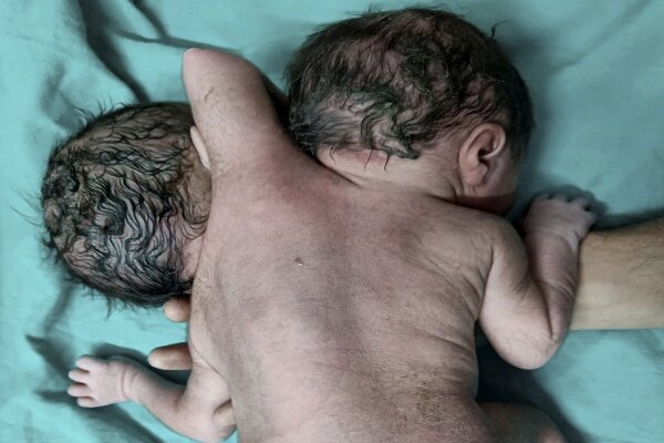 تولد نوزاد با دو سر و ۳ دست در هند