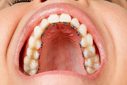 همه چیز درباره ارتودنسی از پشت دندان یا ارتودنسی لینگوال