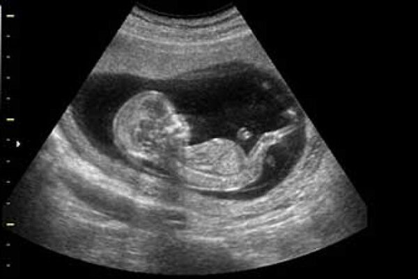 «سونوگرافی» از تمایل به پسرزایی می‌گوید/ دلائل سقط جنین‌های دختر