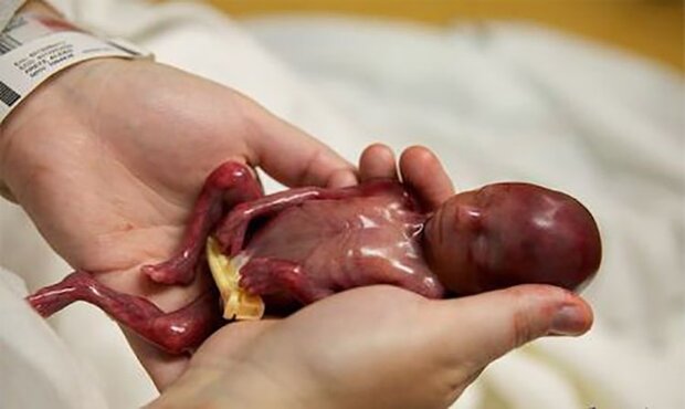 چرا سقط جنین در امریکا آزاد بود؟