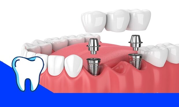 معرفی مرکز ایمپلنت دندان در تهران