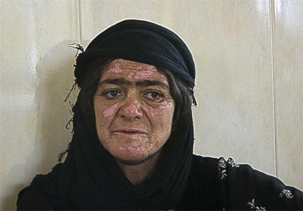 روایتی از بمباران شیمیایی هیروشیمای ایران