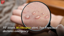 Monkeypox