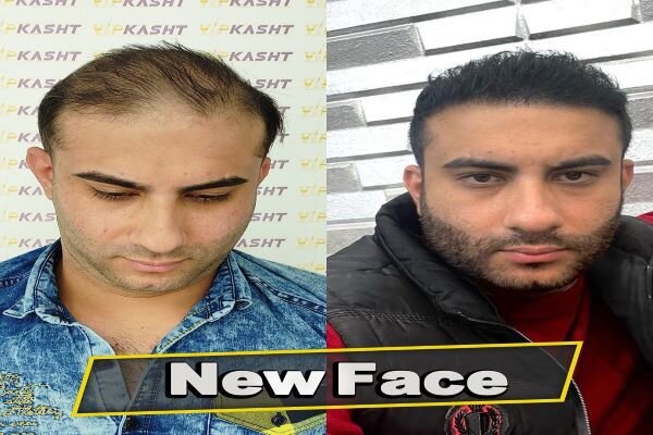 بهترین روش کاشت مو کدام است؟