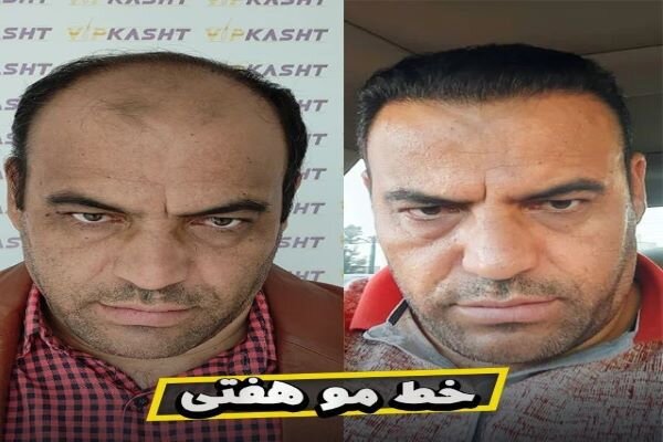 بهترین روش کاشت مو کدام است؟