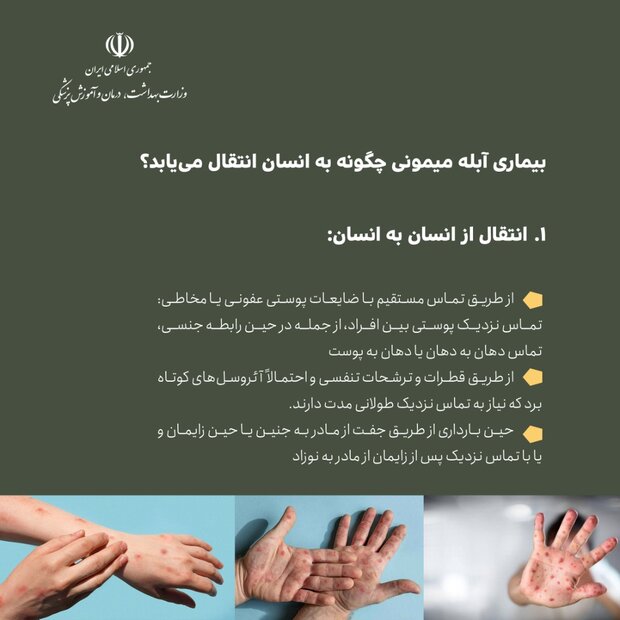 اینفوگرافی آبله میمونی/ از علائم بیماری تا راه های درمان