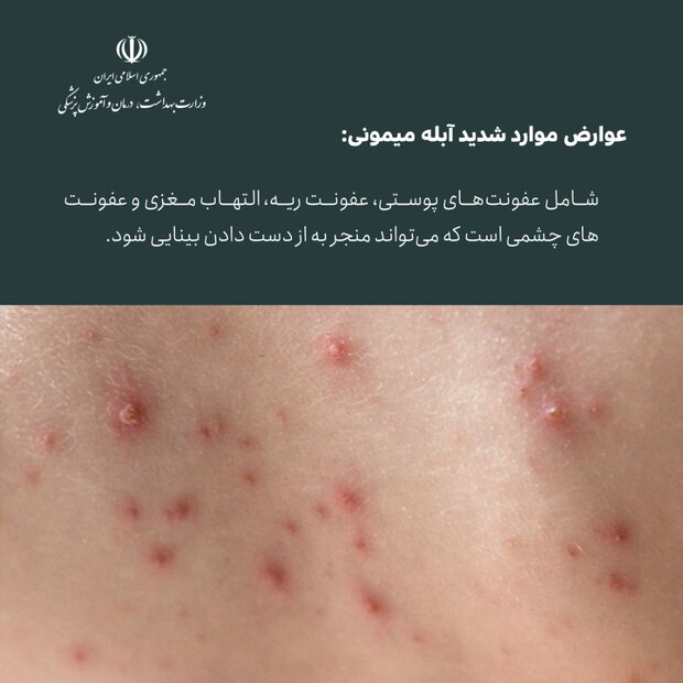 اینفوگرافی آبله میمونی/ از علائم بیماری تا راه های درمان