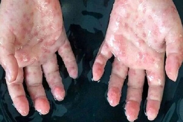 شناسایی آبله میمونی در همسایگی ایران/ بهداشت فردی را جدی بگیرید شناسایی آبله میمونی در همسایگی ایران/ بهداشت فردی را جدی بگیرید