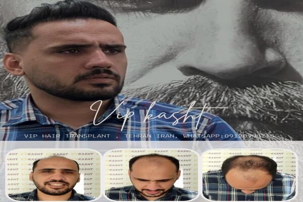 کاشت مو به روش «میکرو اس.یو.تی»