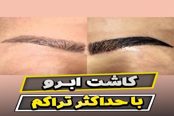 کلینیک کاشت ابرو در تهران