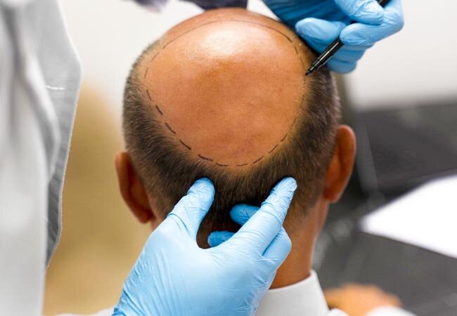 معرفی کلینیک مورد تایید انجمن کاشت موی ایران