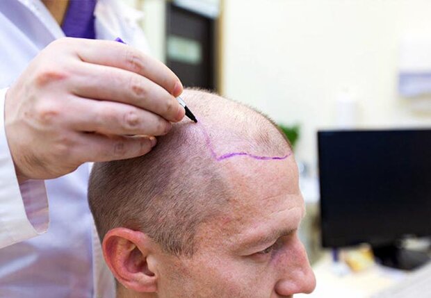 چگونه یک کلینیک کاشت مو معتبر پیدا کنیم؟ 