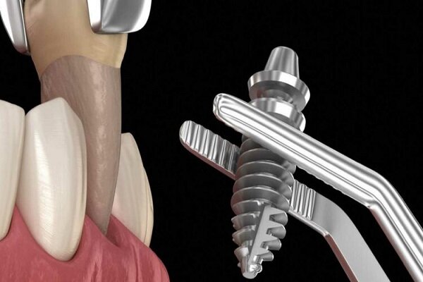 ایمپلنت بدون درد و جراحی چگونه است؟