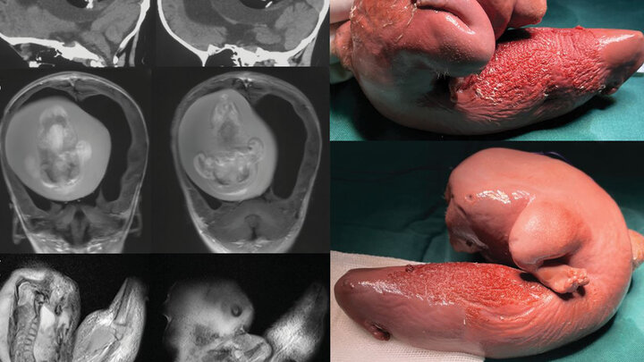 خروج یک جنین مرده از سر خواهرش!