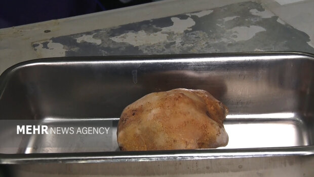 سنگ ۱۶ سانتیمتری از کلیه بیمار در اصفهان خارج شد