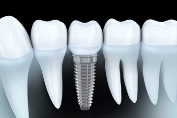 آنچه در مورد ایمپلنت دندان باید بدانید