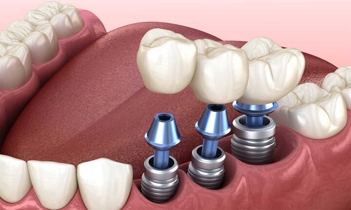 ایمپلنت دندان چیست و چه مراحلی دارد؟
