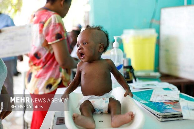 کودکان دچار سوء تغذیه در بیمارستان هائیتی