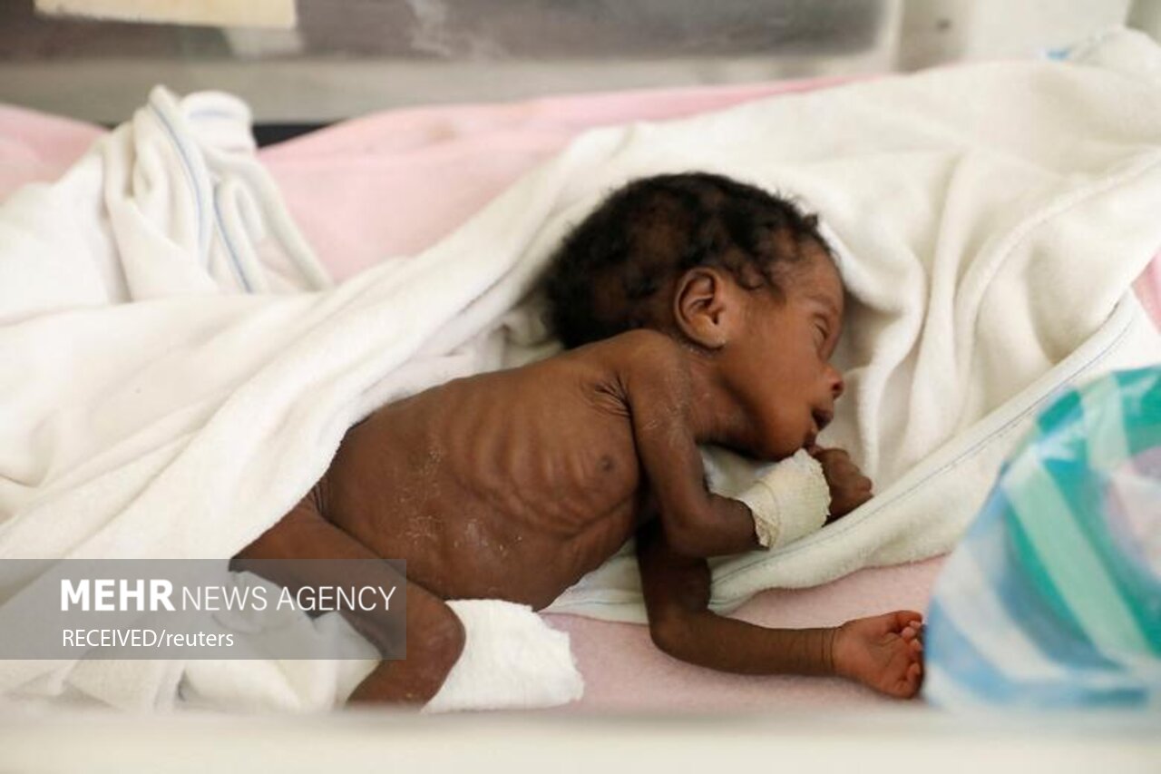 کودکان دچار سوء تغذیه در بیمارستان هائیتی