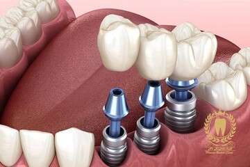 توضیحاتی درباره ایمپلنت دندان