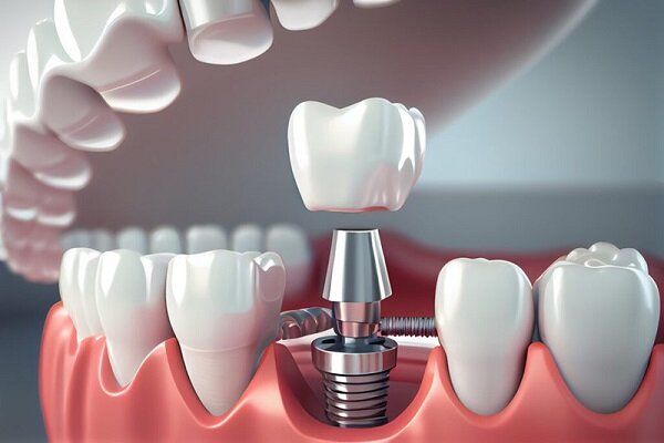 ایمپلنت دندان جایگزینی برای دندان های از دست رفته