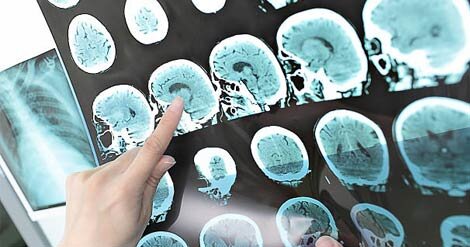 تقسیم عشق در زندگی زوج مبتلا به «ایالاس»/بیماری جزیی از زندگیست