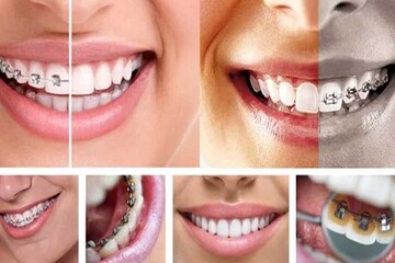 مدت زمان مرتب شدن دندان‌ها در ارتودنسی