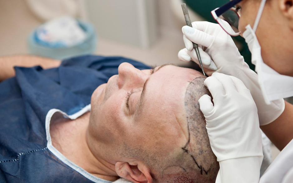 أحدث طريقة لعملية زراعة الشعر بتقنية 3D