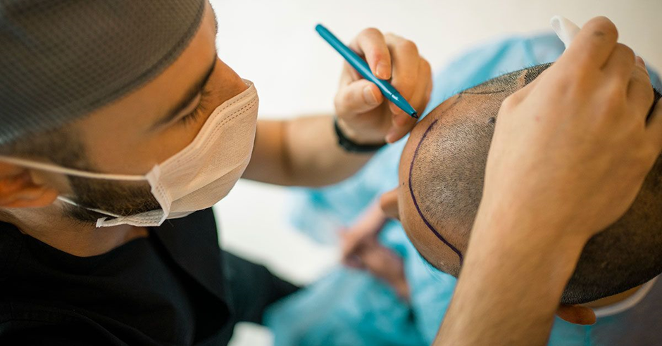 أحدث طريقة لعملية زراعة الشعر بتقنية 3D