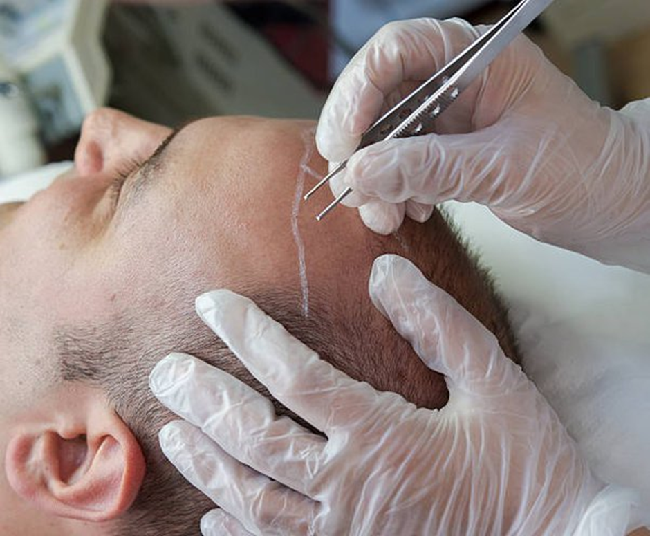 أحدث طريقة لعملية زراعة الشعر بتقنية 3D