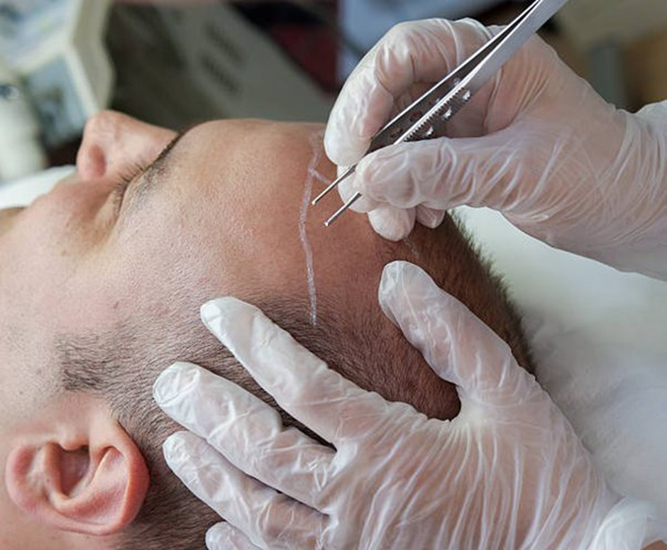 أحدث طريقة لعملية زراعة الشعر بتقنية 3D  